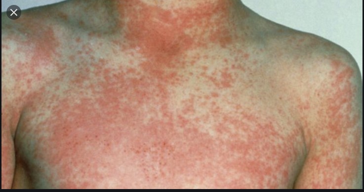 Scarlet fever rash