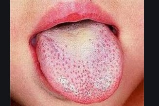 Scarlet fever tongue