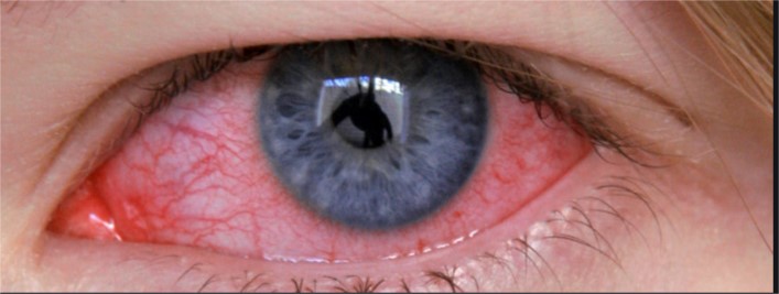 Conjuctivitis   PHOTO