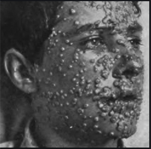 Smallpox   PHOTO