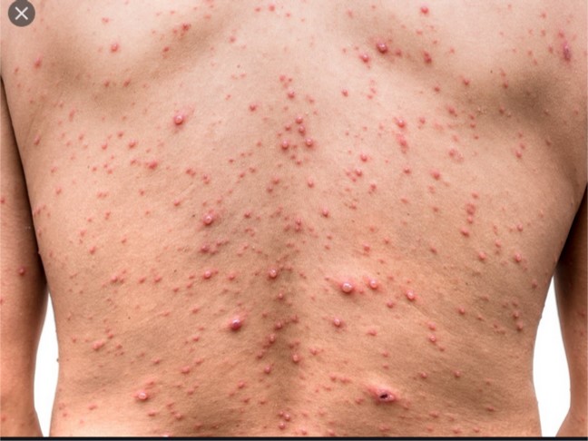 Chickenpox   PHOTO