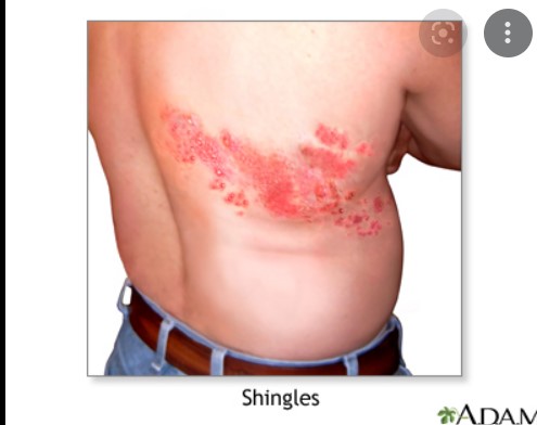 shingles