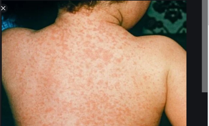 Measles   PHOTO