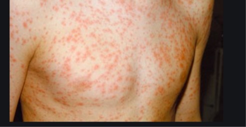 German measles   PHOTO