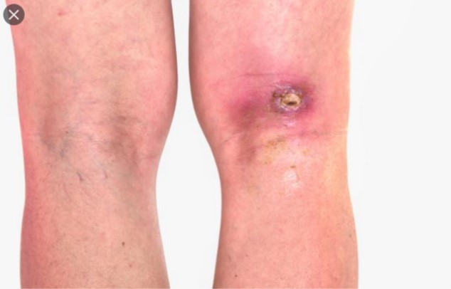 Skin abscess Staph   PHOTO