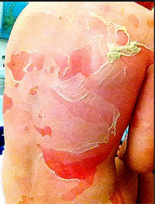 Scalded skin syndrome   PHOTO