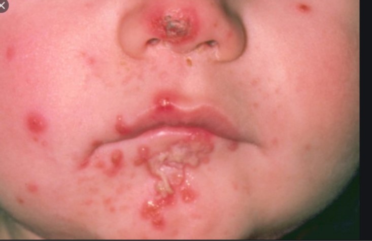 Impetigo   PHOTO