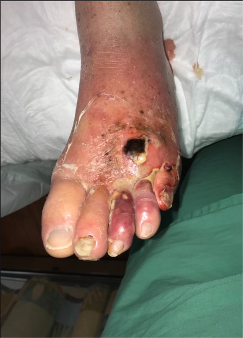 Necrotizing fasciitis   PHOTO