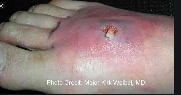 MRSA  skin abscess   PHOTO