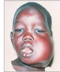 Burkitts lymphoma   PHOTO