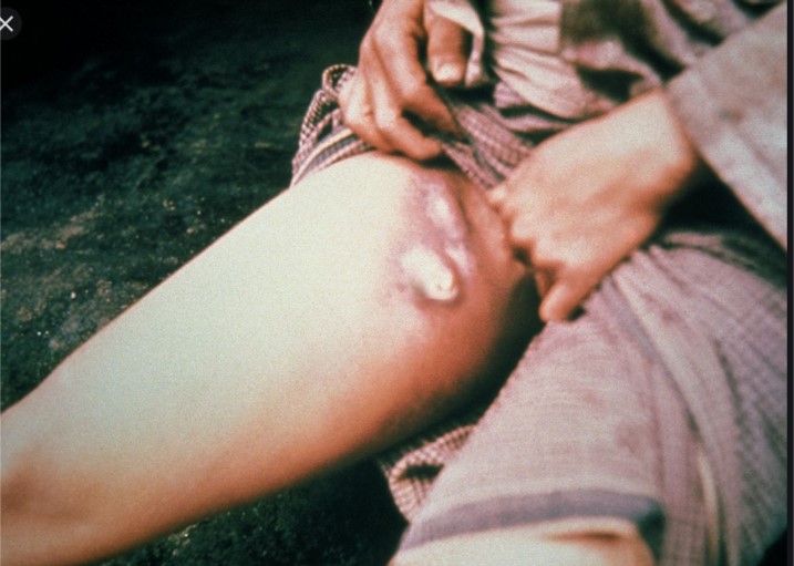 Bubonic plague   PHOTO