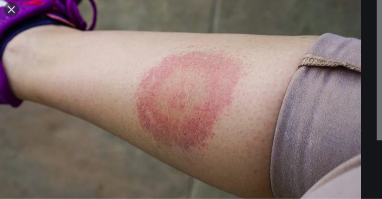 Lyme disease   PHOTO
