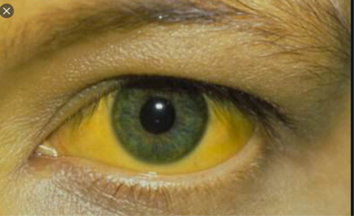 hepatitis jaundice   PHOTO