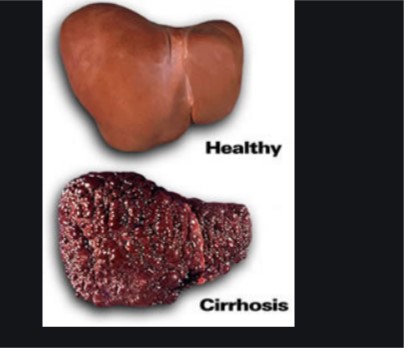 Hepatitis liver   PHOTO
