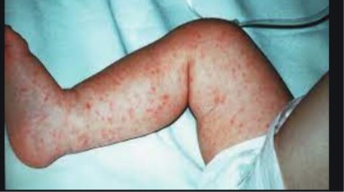 meningitis petechiae   PHOTO